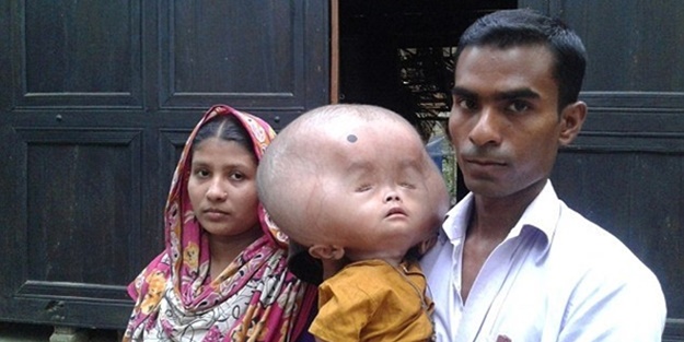 Bu çocuğun kafası tam 9 kilo ağırlığında!