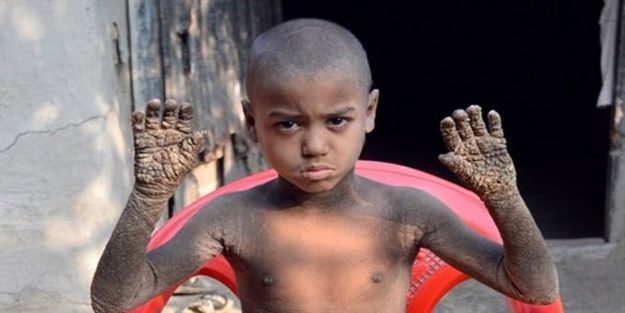 Bu çocuğun vücudu ‘taşlaşıyor’