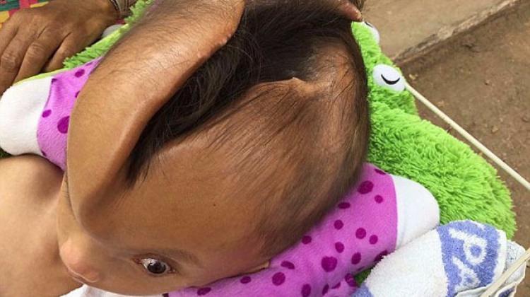 Bu çocuk kafasında dev yarıkla doğdu!