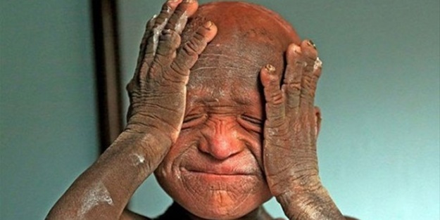 Bu çocuk yavaş yavaş taşa dönüşüyor!