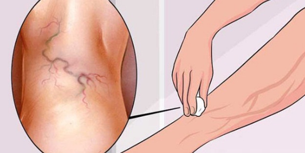 Bu doğal yöntemle varislerinizden kurtulun