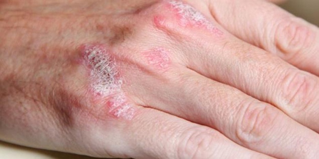 Bu gıdalar sedef hastalığını tetikliyor