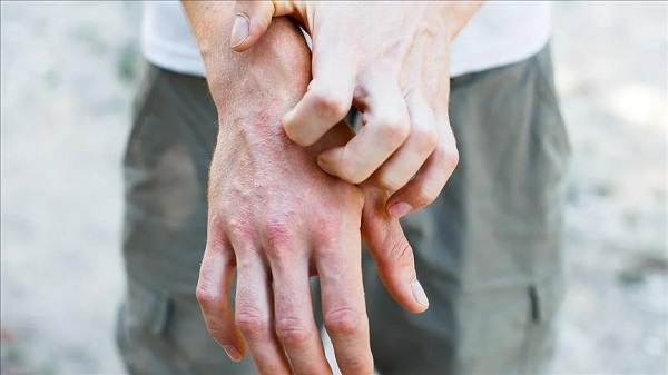 Bu hastalığa dikkat! Geceleri kaşıntınız artıyor mu?