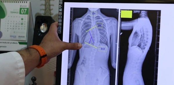 Bu hastalık kız çocuklarında daha sık görülüyor