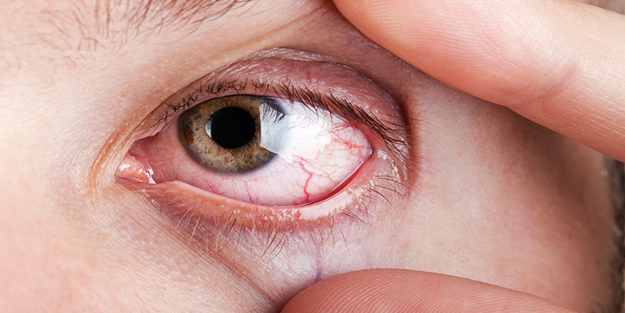 Bu hastalık körlüğe neden oluyor!