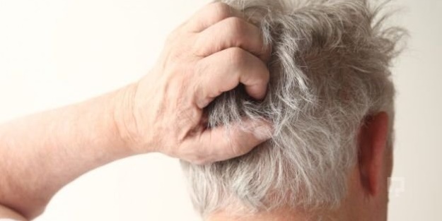 Bu hastalık saç yolduruyor!