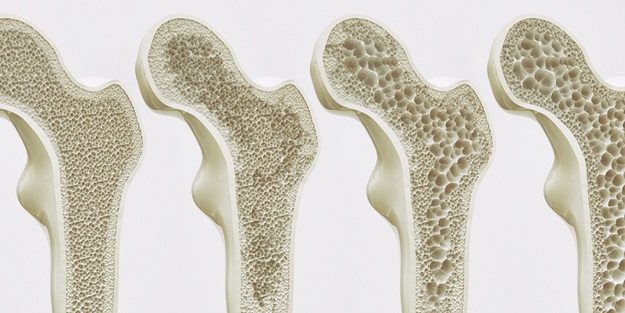 Bu hastalıklar kemik sağlığını tehdit ediyor!