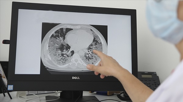 Bu hastalıkta ölüm oranı yüksek