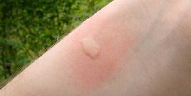 Bu ısırığa turşu suyu sürerseniz...