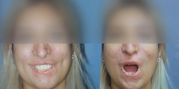 Bu kadar kolaymış deyip göze alıp yapanlar! Estetik uyarısı: Bakın vücudunuzda neler oluyor?