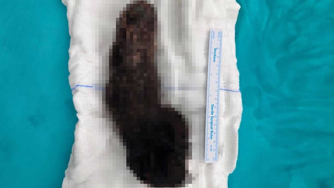 Bu nasıl olabilir? 15 yaşındaki çocuğun midesinden çıkan şoke etti