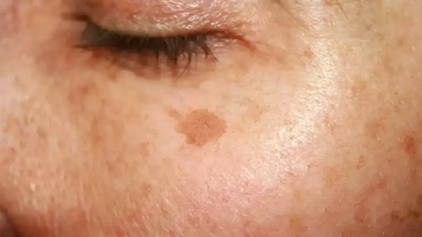 Bu sorun yaz aylarında artış gösteriyor