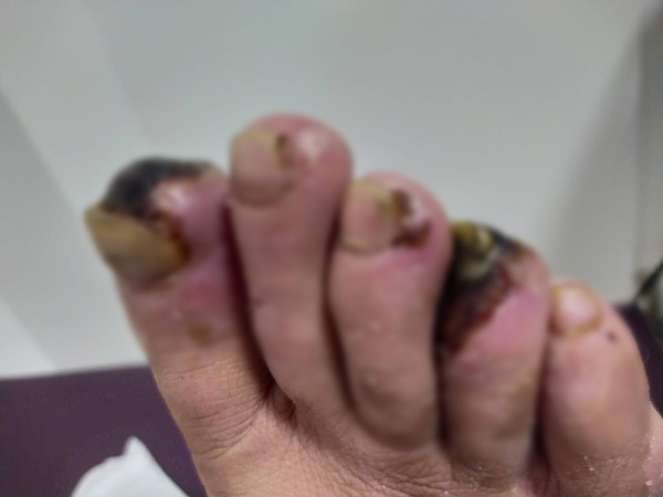 Bu tedaviyle parmakları kurtarıldı