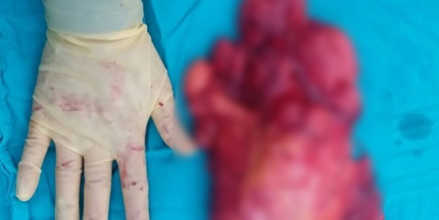 Bu tümör bacağından çıktı