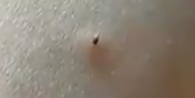 Bu uyarıya dikkat! Kene erken çıkartılırsa…