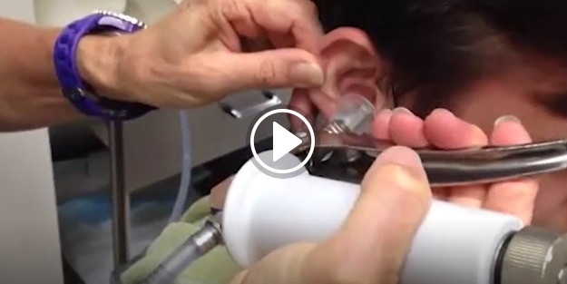 Bu videoyu izledikten sonra bir daha kulak çubuğu kullanmayacaksınız!