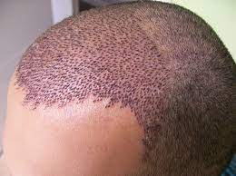 Bu yapılsın diye artık 24 saat uçan var! Saç ekimi için Almanya ,Yunanistan, Bulgaristan ülkelerinden geliyorlar