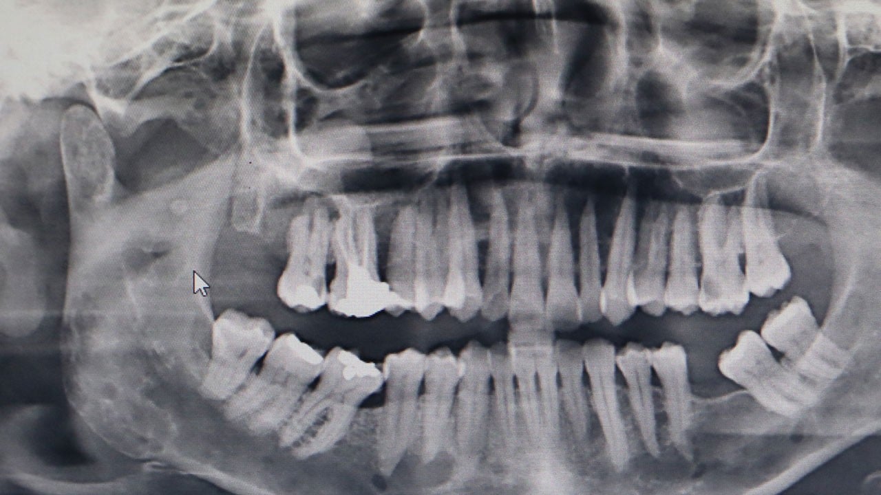 Bu yaralar 2 haftadan uzun sürüyorsa dikkat! Ölümle sonuçlanabiliyor