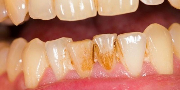 Bu yöntemle 5 kez fırçalarsanız...