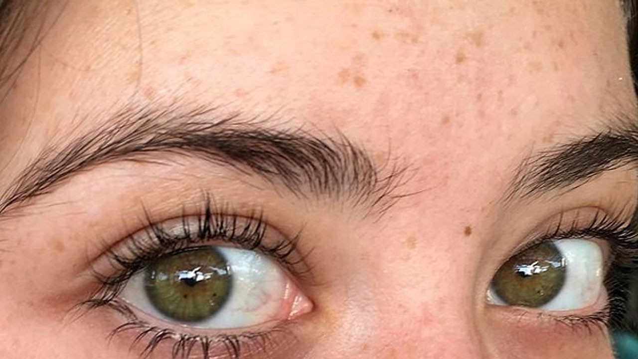Gözde seğirme nasıl geçer? İşte yanıtları