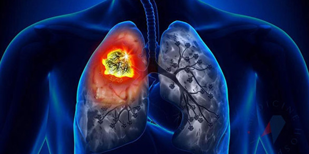 Bunları yaşayanlar dikkat! İşte akciğer kanserinin en yaygın 15 belirtisi...