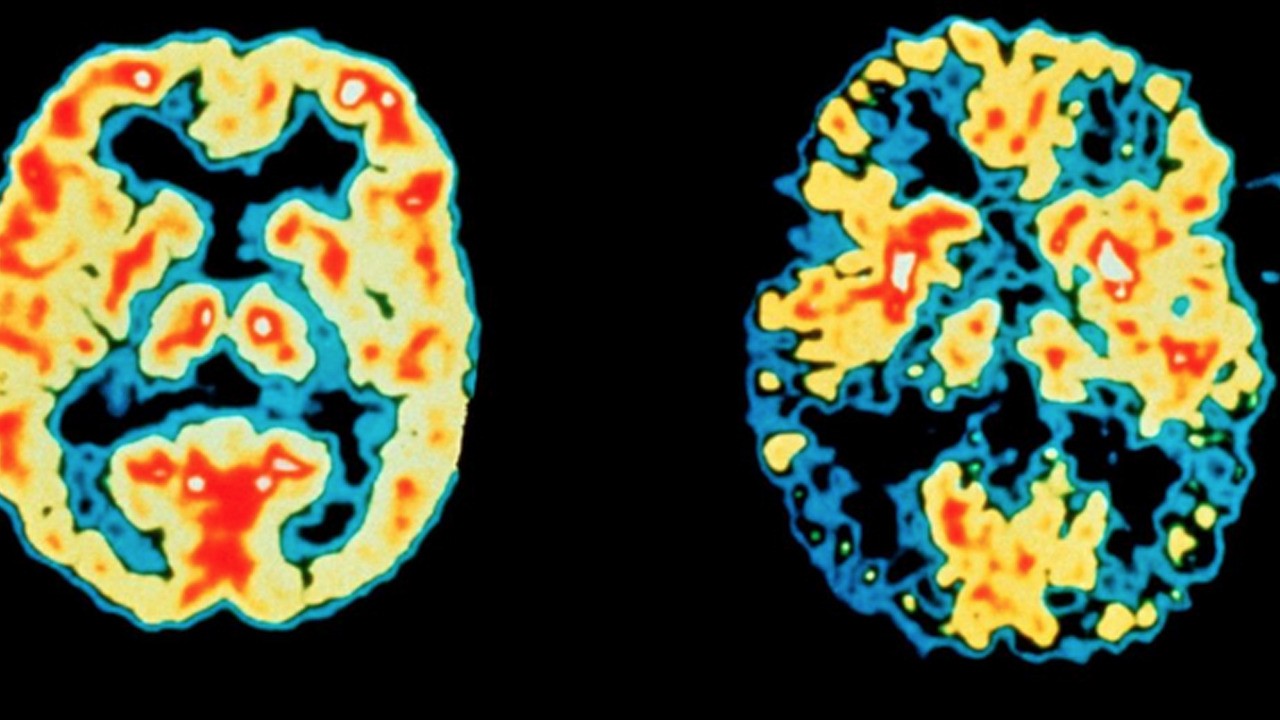 Bunu asla yapmayın! Bu alışkanlık beyni sessizce yok ediyor uyarısı!