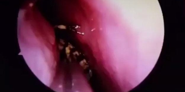 Burnu kaşınınca hastaneye gitti, hayatının şokunu yaşadı!