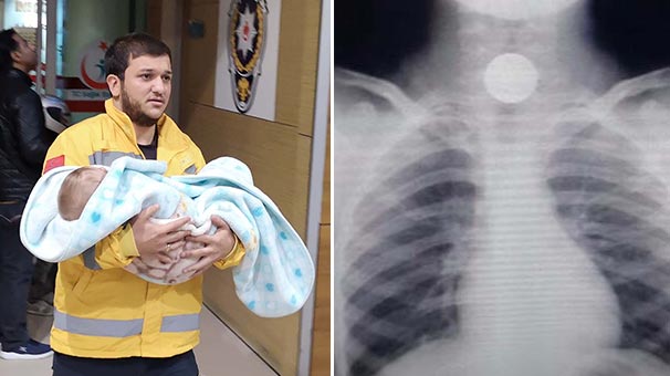 Bursa'da bebeğin yemek borusuna kaçan 50 kuruş operasyonla çıkarıldı