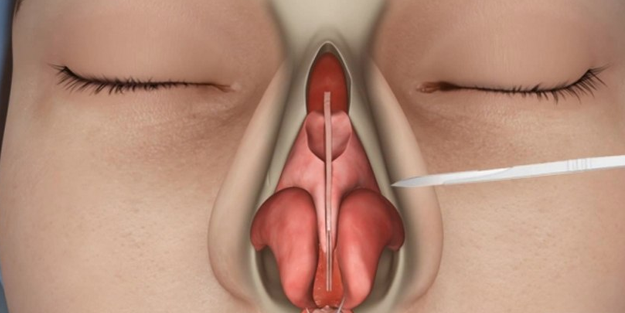 Burun estetiği ameliyatı sonrası uyanamayan kadın öldü