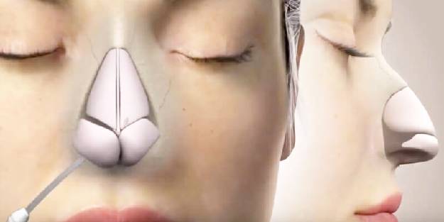 Burun revizyonundaki tehlikeye dikkat