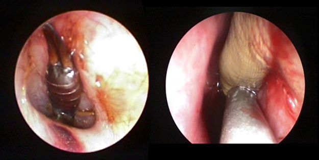Burundan sülük, kulaktan böcek çıktı