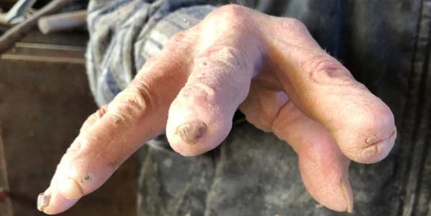 Bütün parmaklarını kaptırdı ama yine de vazgeçmedi!