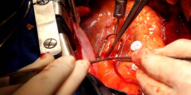 Bypass ameliyatı tarih oluyor