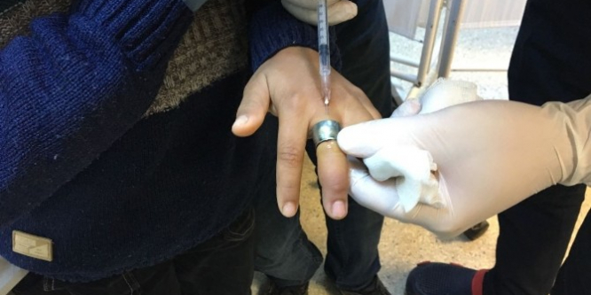 Çocuğun parmağına sıkışan yüzük hastanede çıkartıldı