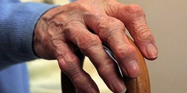 Canan Karatay’dan romatoit artrit bitkisel tedavisi! Romatoid artrit beslenme ve yenmemesi gerekenler