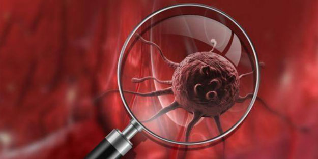 Çarpıcı kanser kanser araştırması! Vakaların yüzde 40'ı hızla yayılan sorunla ilgili