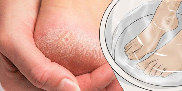 Çatlamış topukları anında iyileştiriyor! Tırtıklı ayak tabanını pamuk gibi yumuşacık yapan doğal yöntemler