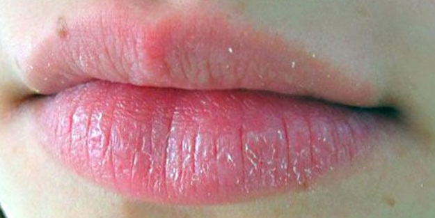 Çatlayan dudaklara çözüm