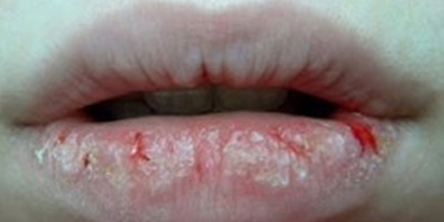 Çatlayan dudaklara süt peelingi!