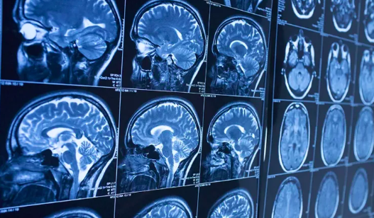 Cep telefonları beyin kanseri riskini artırıyor mu? DSÖ açıkladı