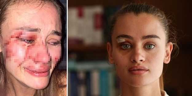 Çeşme'de dayak yiyen model koronavirüse yakalandı