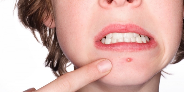 Çıbanı doğal yollarla geçirmek için...