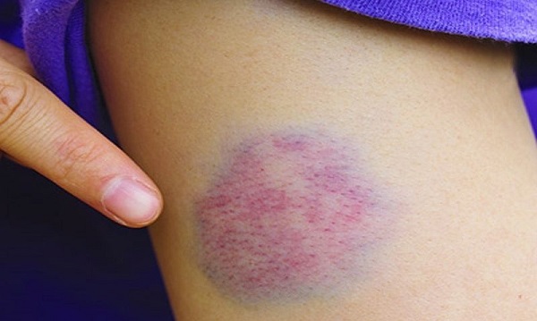 Ciddi sağlık sorunlarına yol açabiliyor! Aman dikkat 'Morluk' deyip geçmeyin