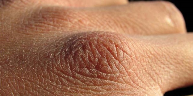 Cildiniz böyleyse dikkat!