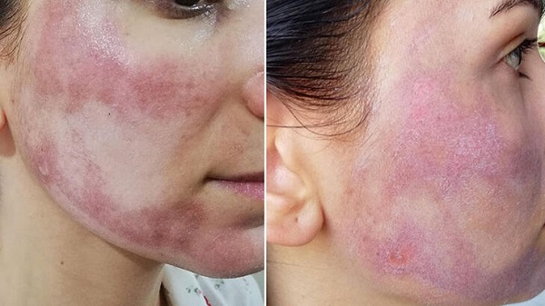 Cilt bakımı kabusu oldu!