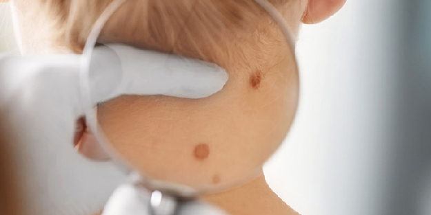 Cilt kanseri belirtileri nelerdir?