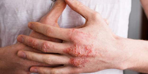 Cilt Kanseri erken tanısında önemli adım