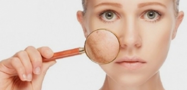 Cilt lekeleri kâbusunuz olmasın