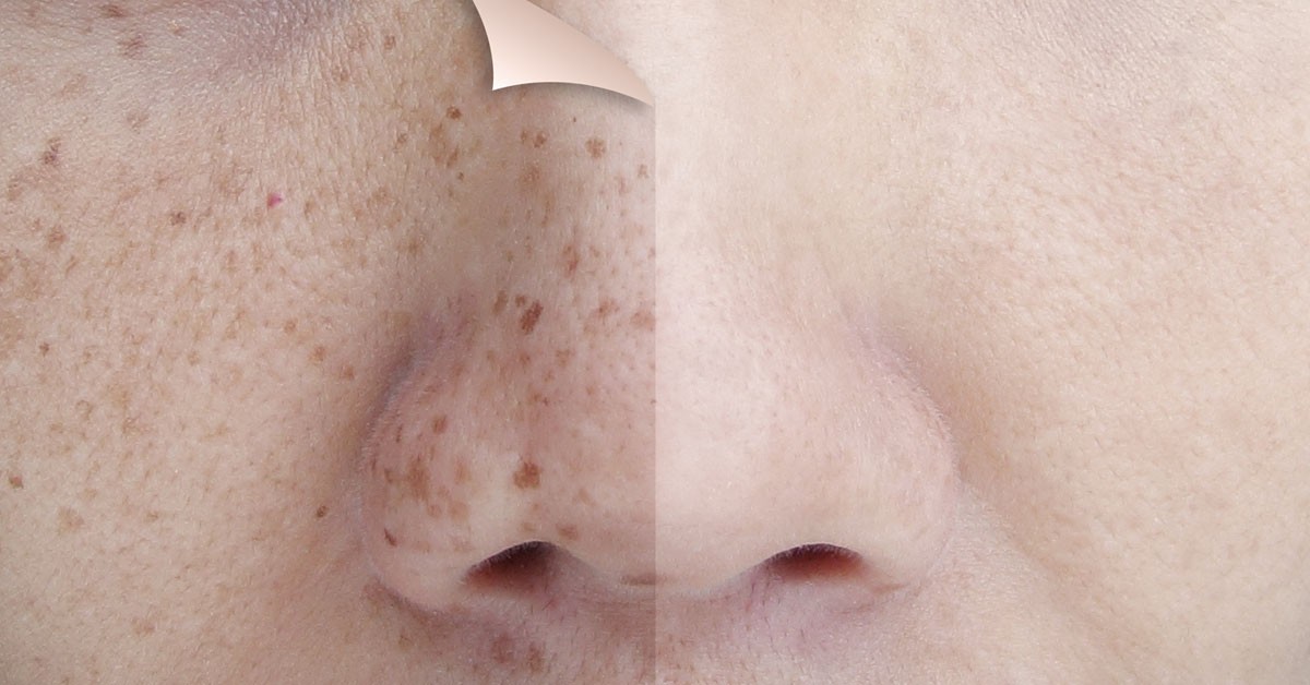 Cilt lekelerinden kurtulmak için tedavinin tam zamanı