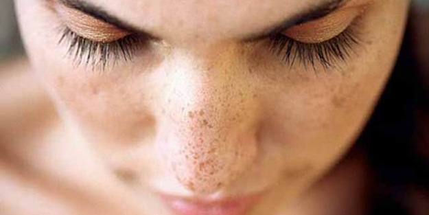 Cilt lekelerini gidermenin doğa yöntemleri Cilt lekesi nedir? Cilt lekesi nasıl geçer?